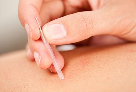 Acupuncture for auto accident injury